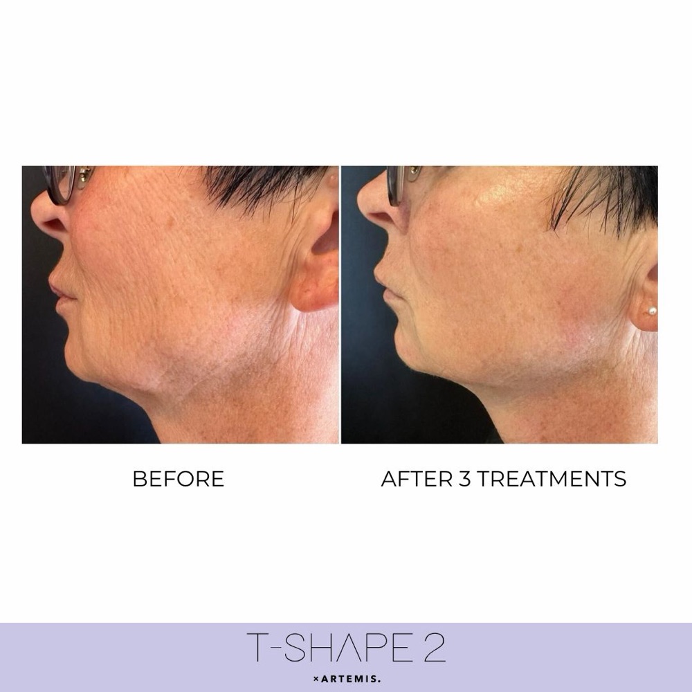 T-Shape 2 before and after: face, 3 treatments