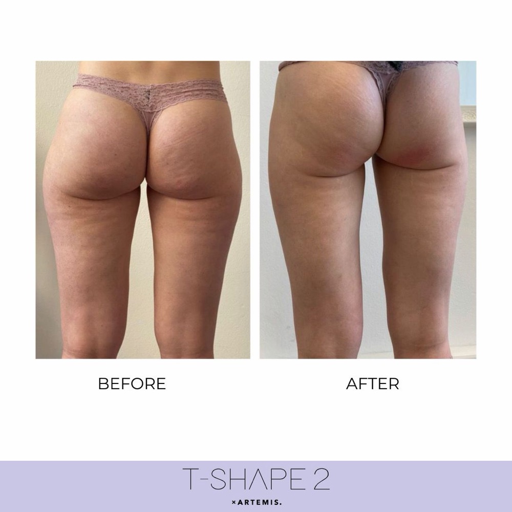 T-Shape 2 before and after: glutes and cellulite