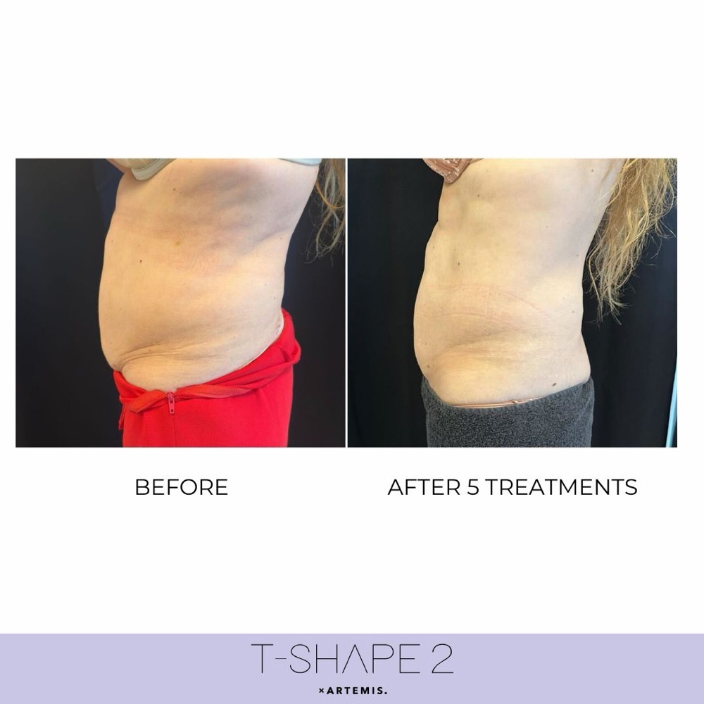 T-Shape 2 before and after: stomach, 5 treatments