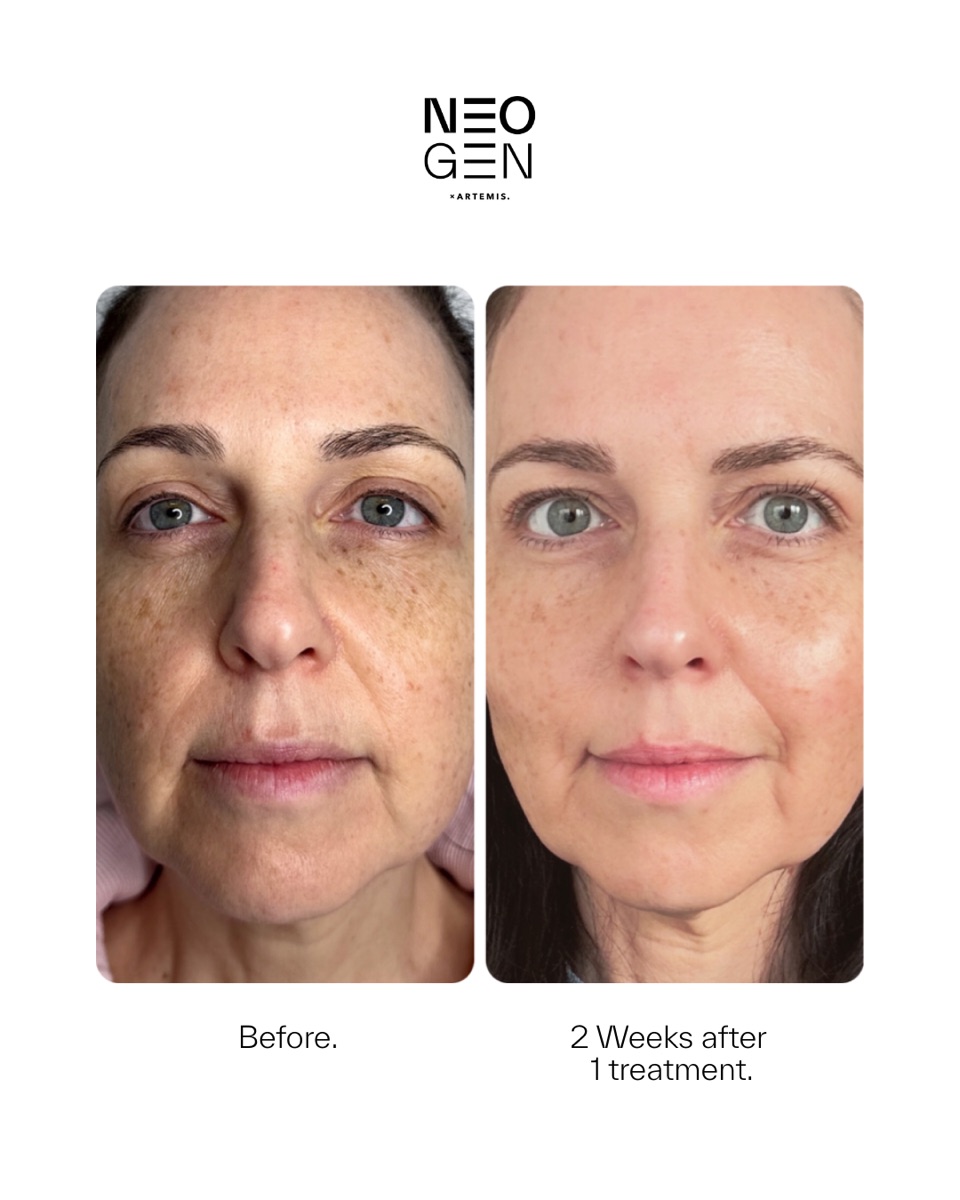 Neogen before and after: 2 weeks after 1 treatment