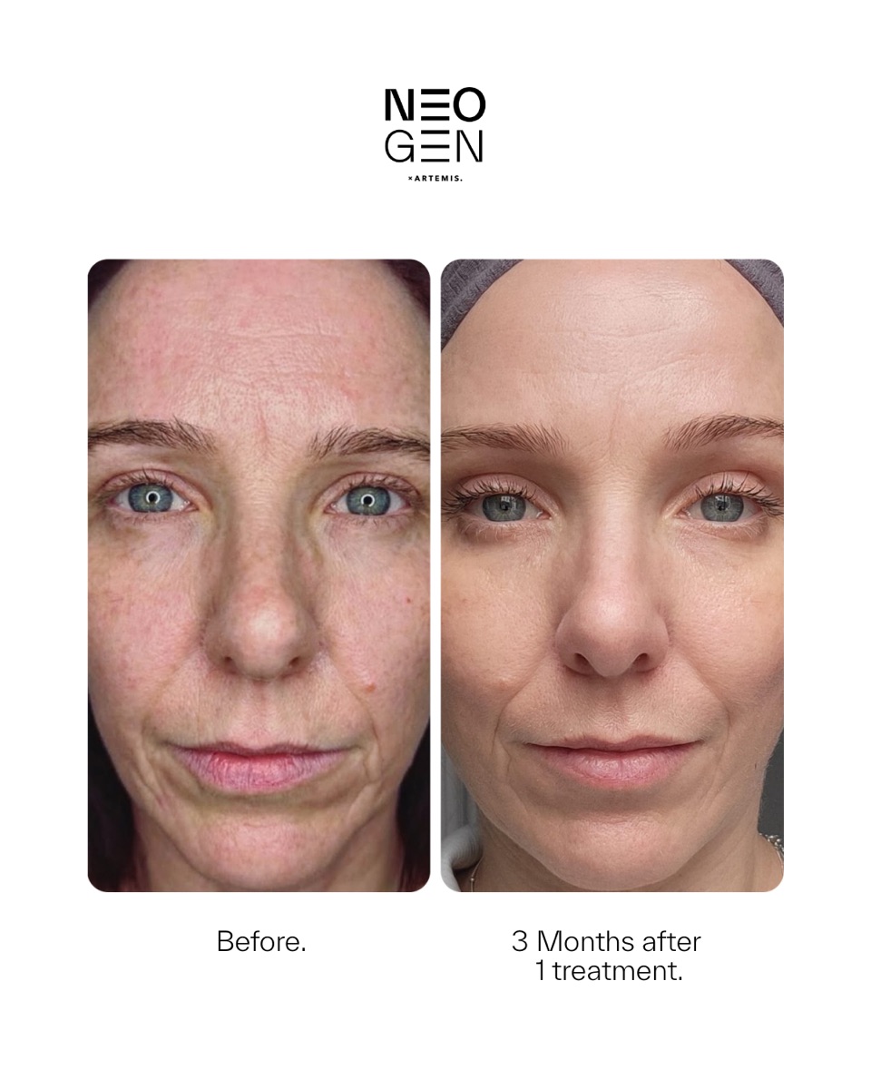 Neogen before and after: 3 months after 1 treatment