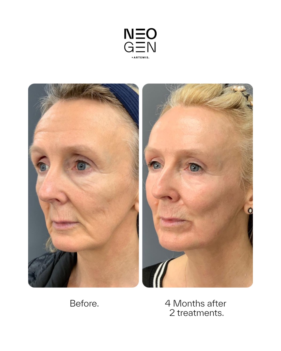 Neogen before and after: 4 months after 2 treatments